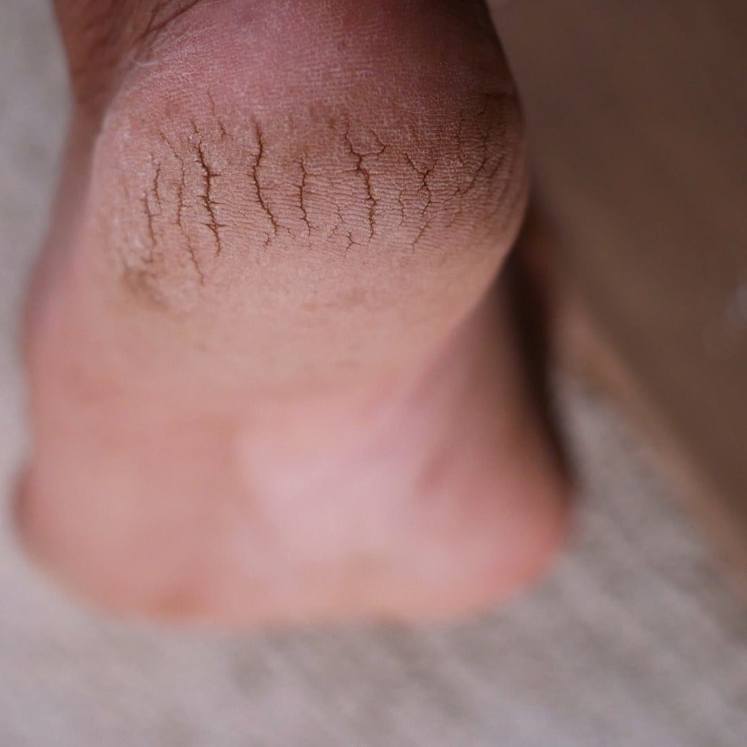 Dry, cracked heel