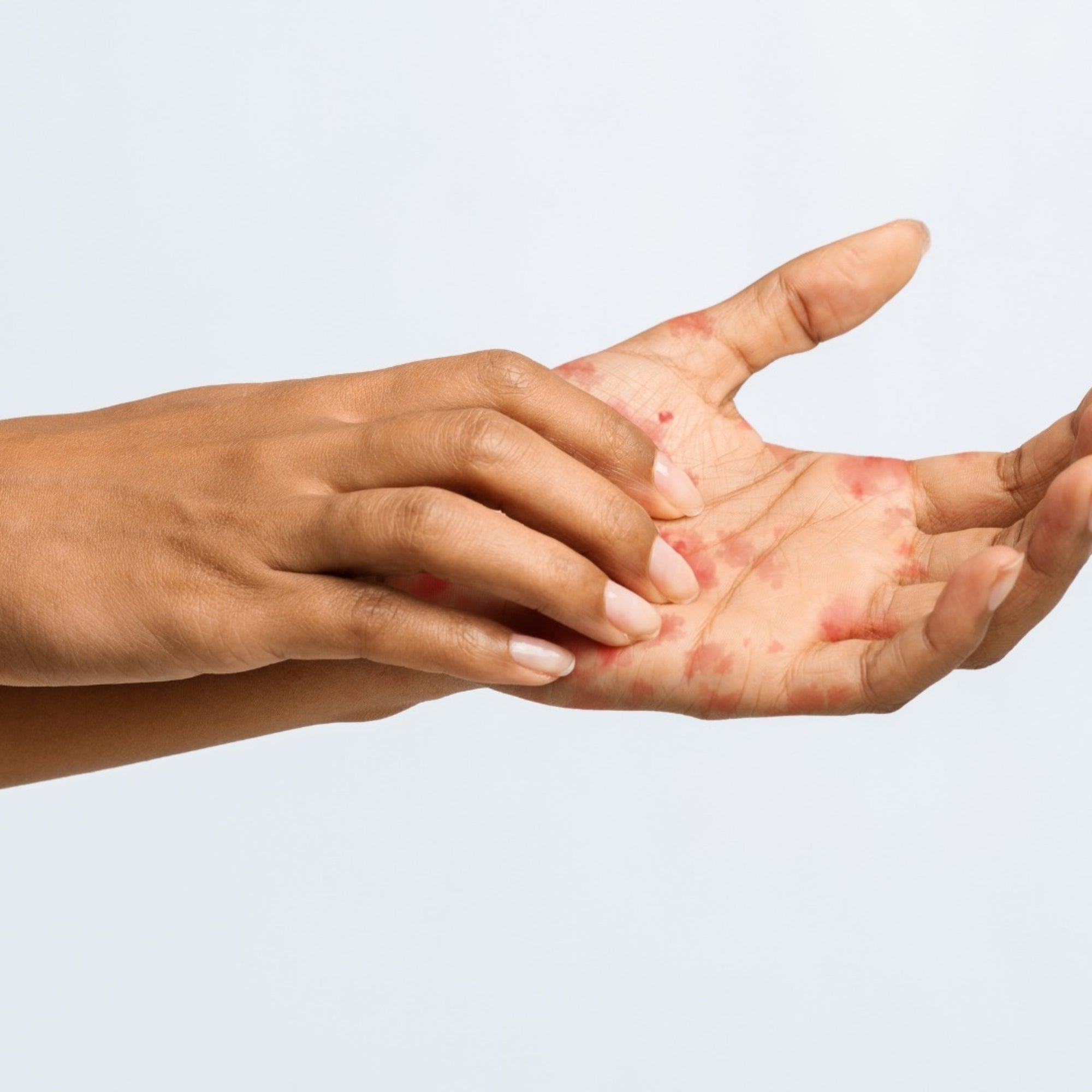 Hand with signs of Eczema