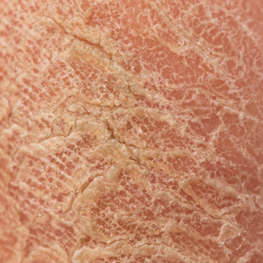 Signs of skin dryness and cracks on leg