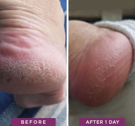 Dry, callused heels before and after using Rapid Crack Repair Cream for one day