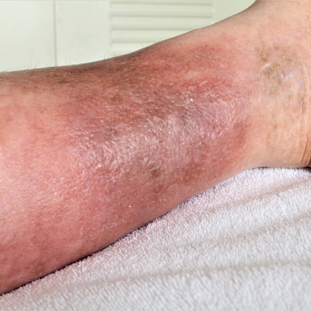 Venous Insufficiency & Itchy Legs: The Skin Risk