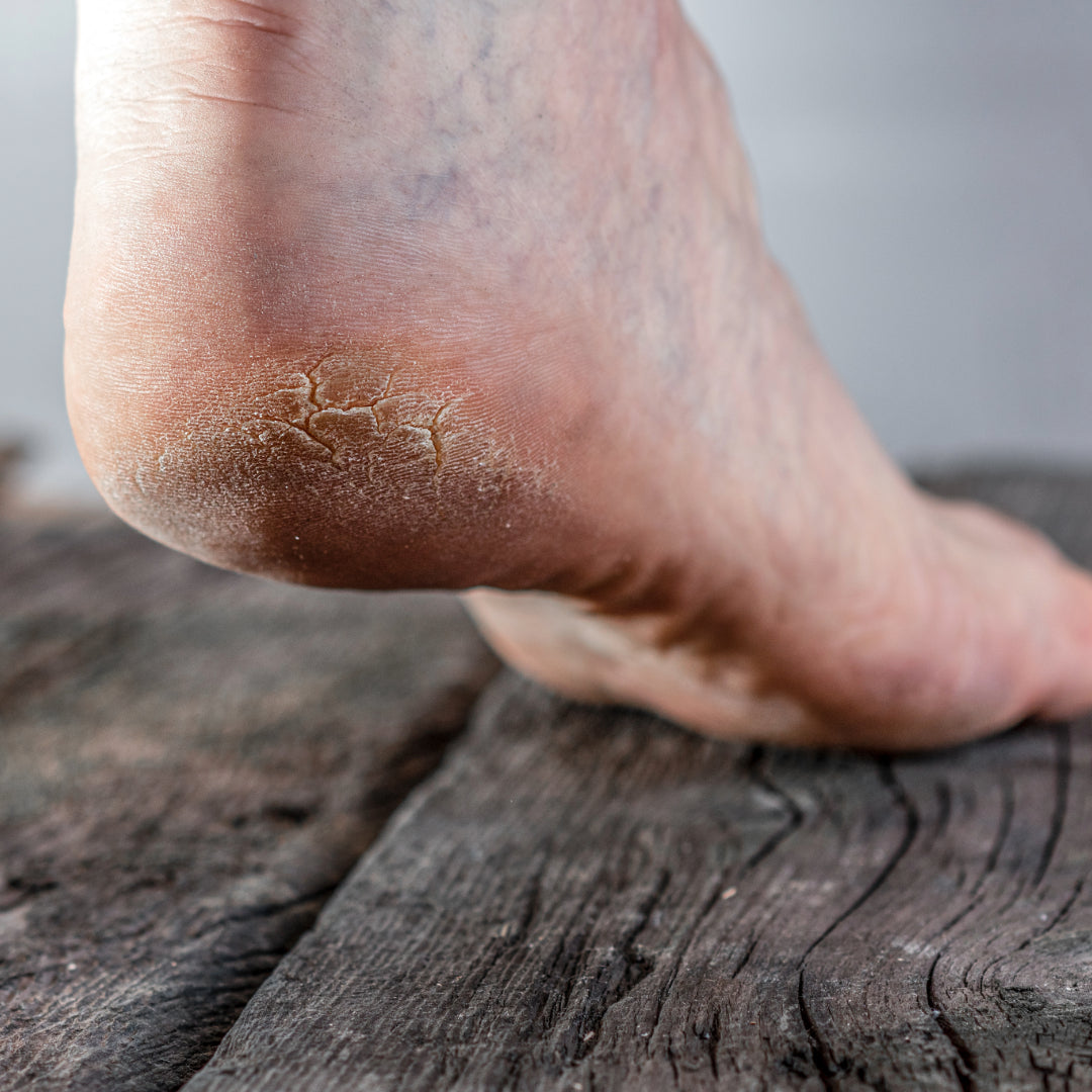 Foot with cracked heel