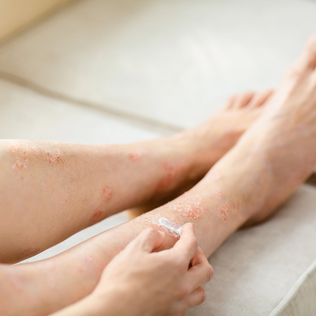 Diabetic Itchy Skin: What It Means and When to Worry