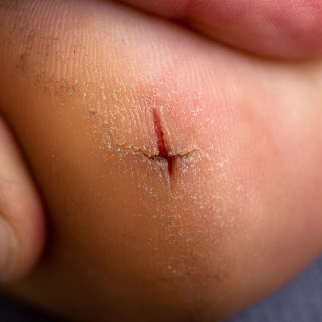 Close-up of a deep cracked heel with dry, peeling skin—a common issue in diabetic foot care.