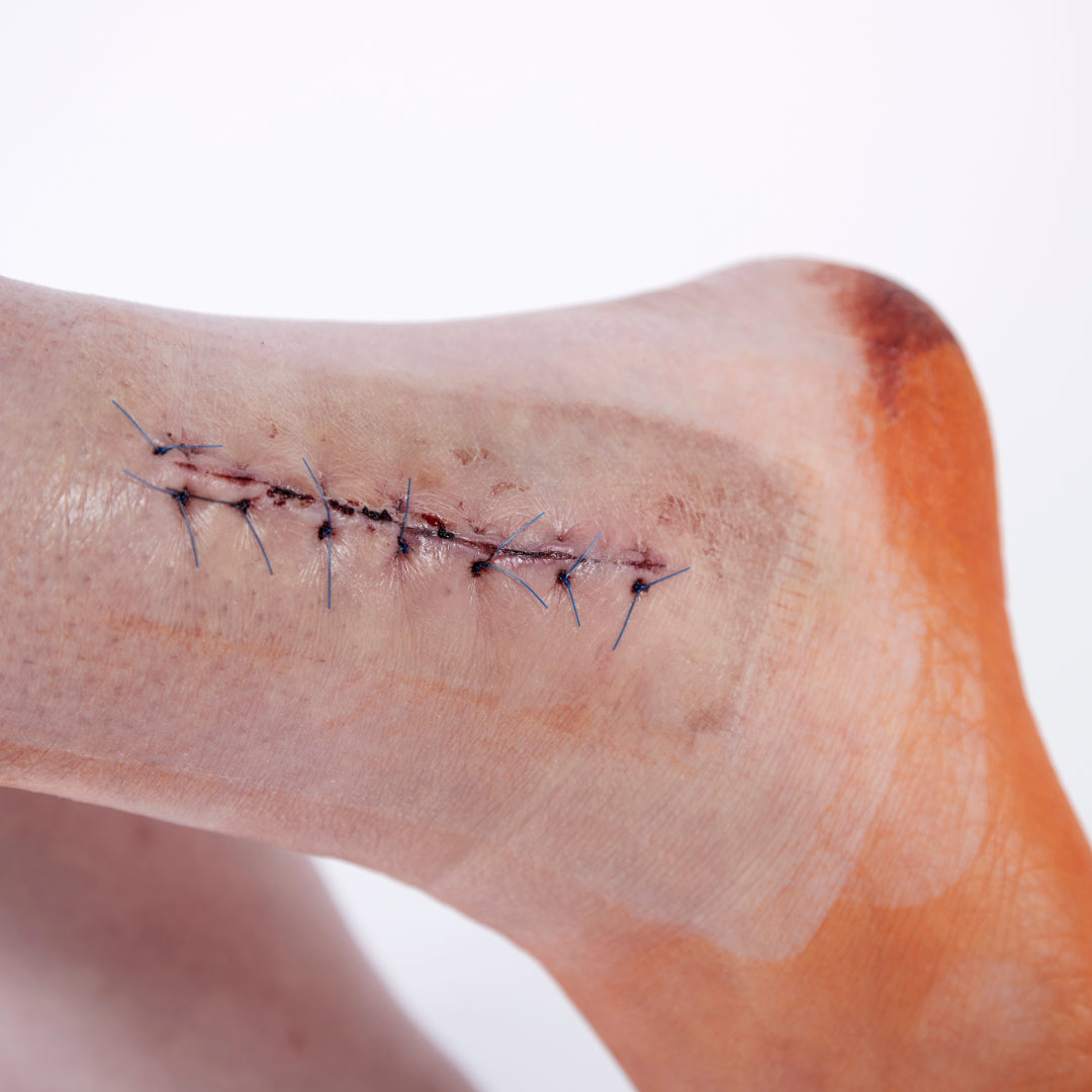 healed surgical incision on an ankle after suture removal