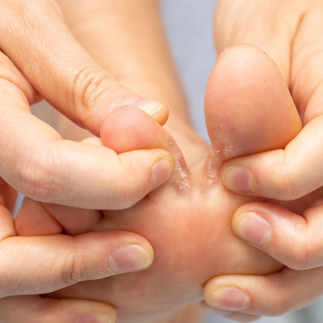 Image of foot with symptoms of Athlete's Foot