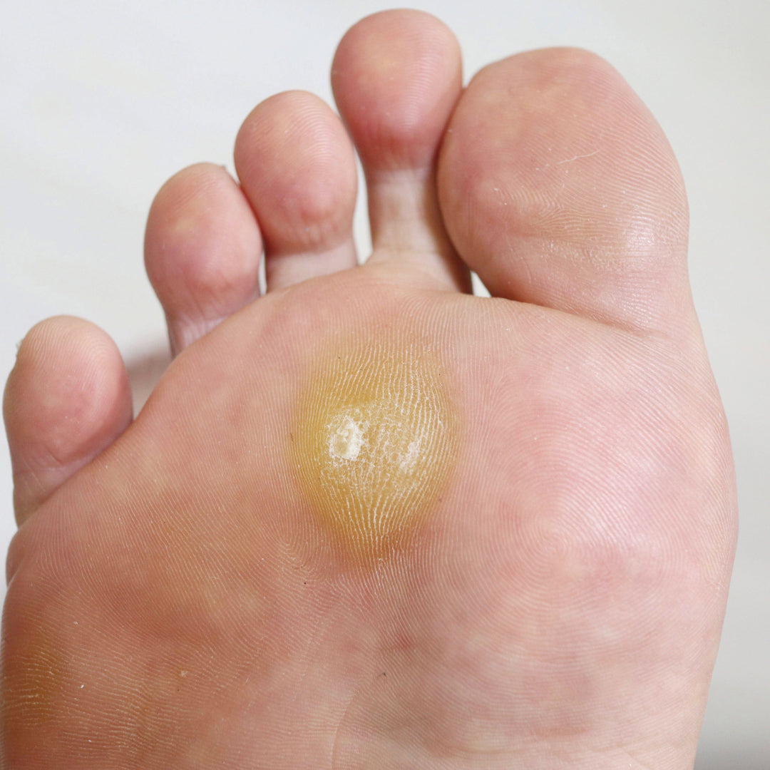Thickened yellow callus on the ball of the foot beneath the metatarsal heads