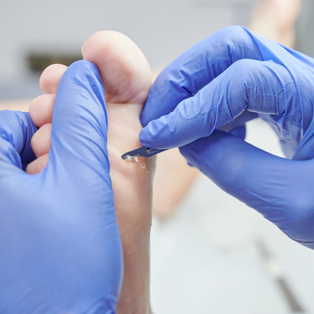 Callus debridement