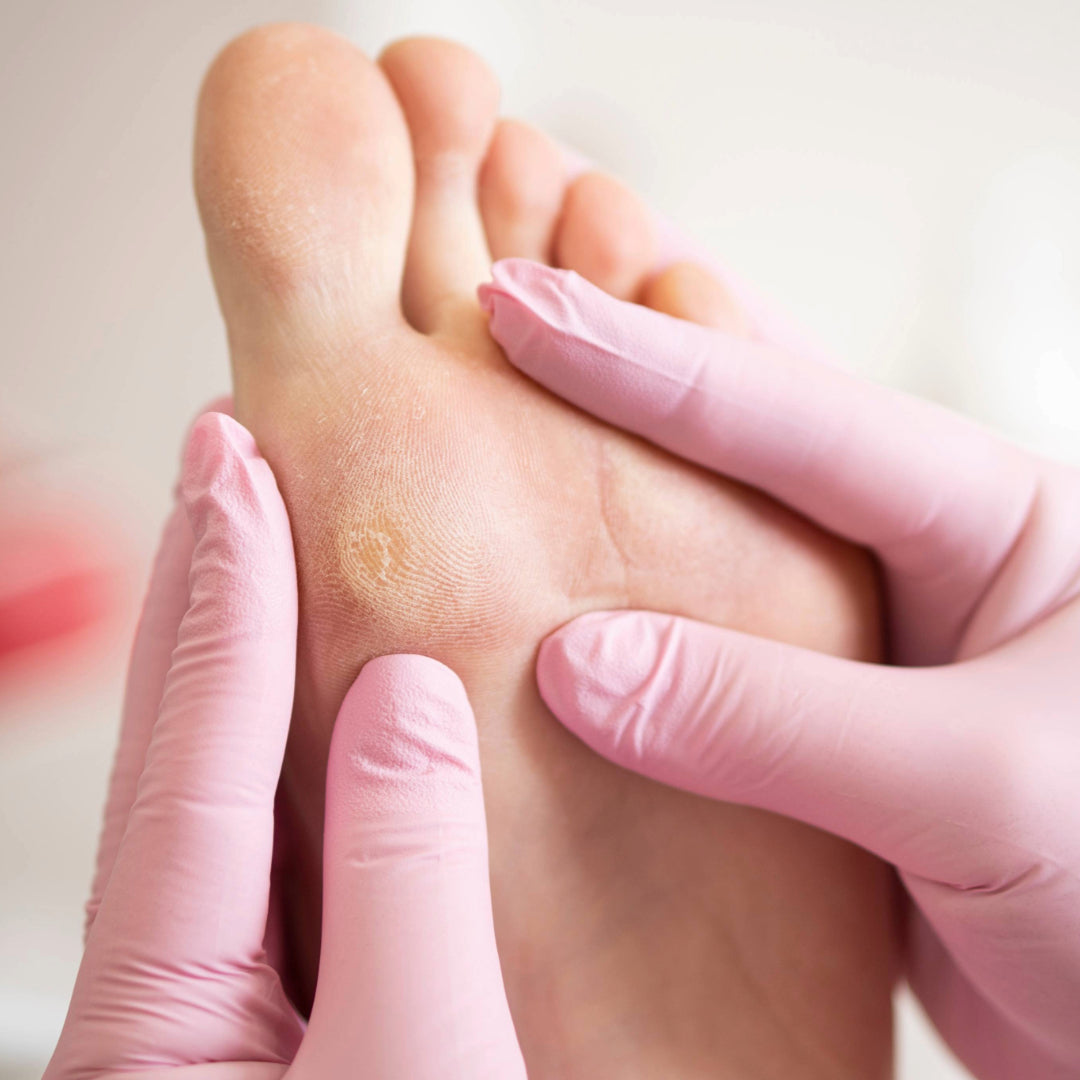 Gloved hands examining a yellow callus on the ball of the foot