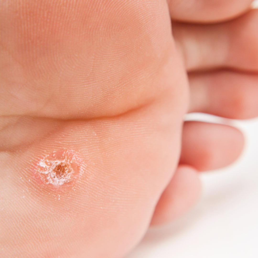 Image of a foot callus