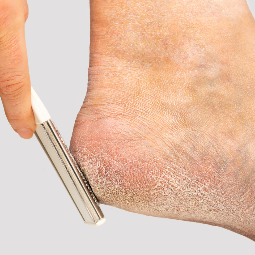 Skip Cheese-Graters: Safe Callus Care for Diabetic Feet