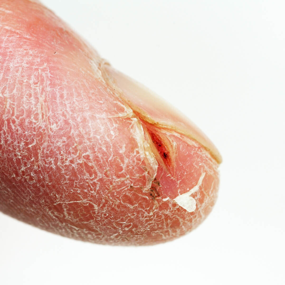 Painful Cracked Fingertips: Causes & How to Heal Them