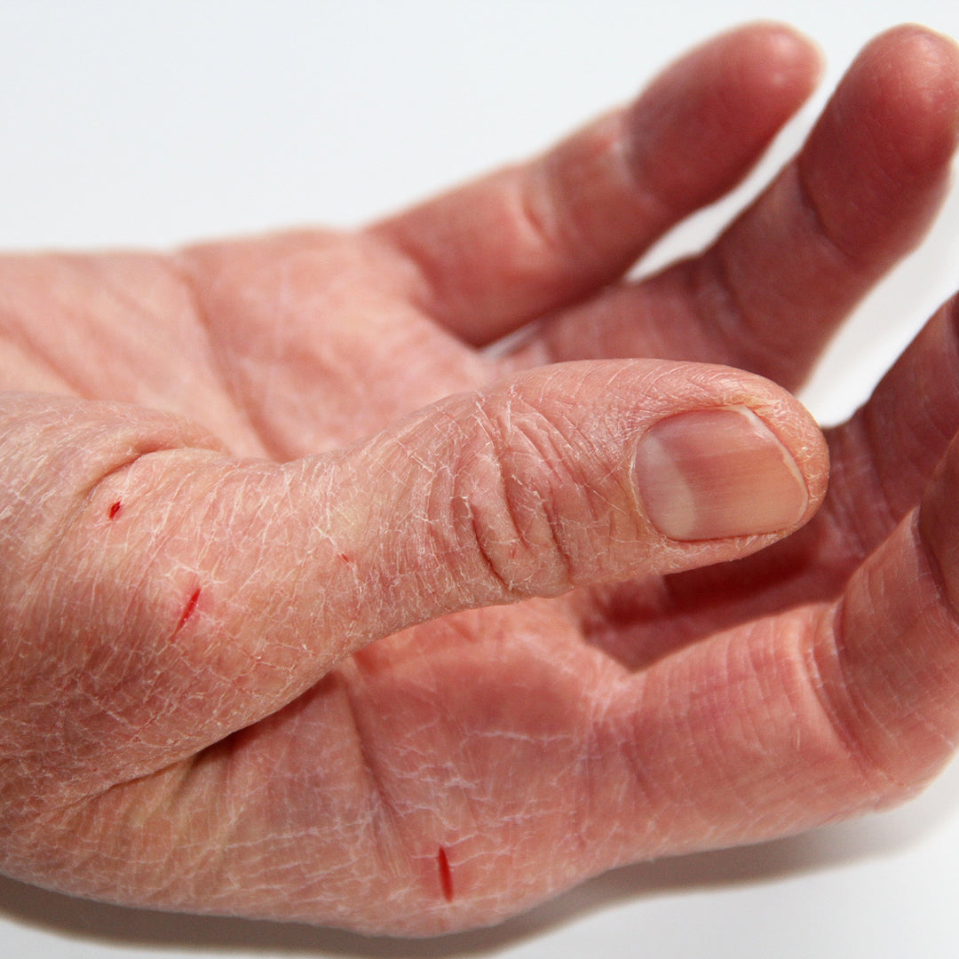 An open hand with dry, deeply cracked skin and several small splits across the palm and base of the thumb, some of them bleeding