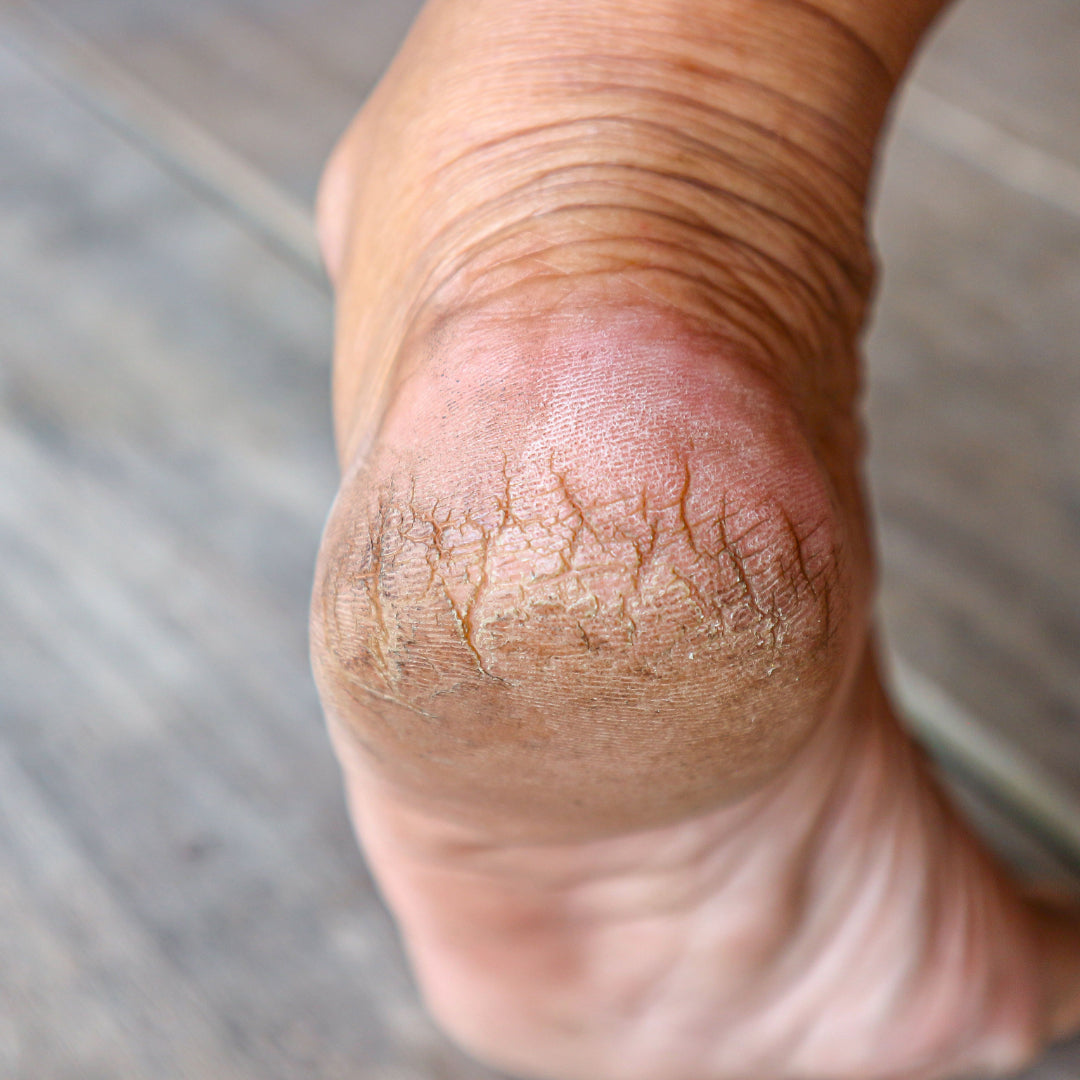 A close-up of a bare heel with dry, thickened, cracked skin