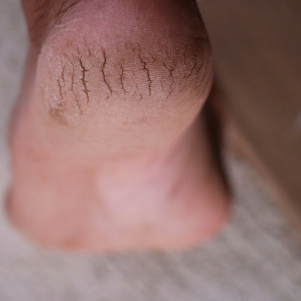 Say Goodbye to Dry, Cracked Feet in Cold Weather | Foot Solutions
