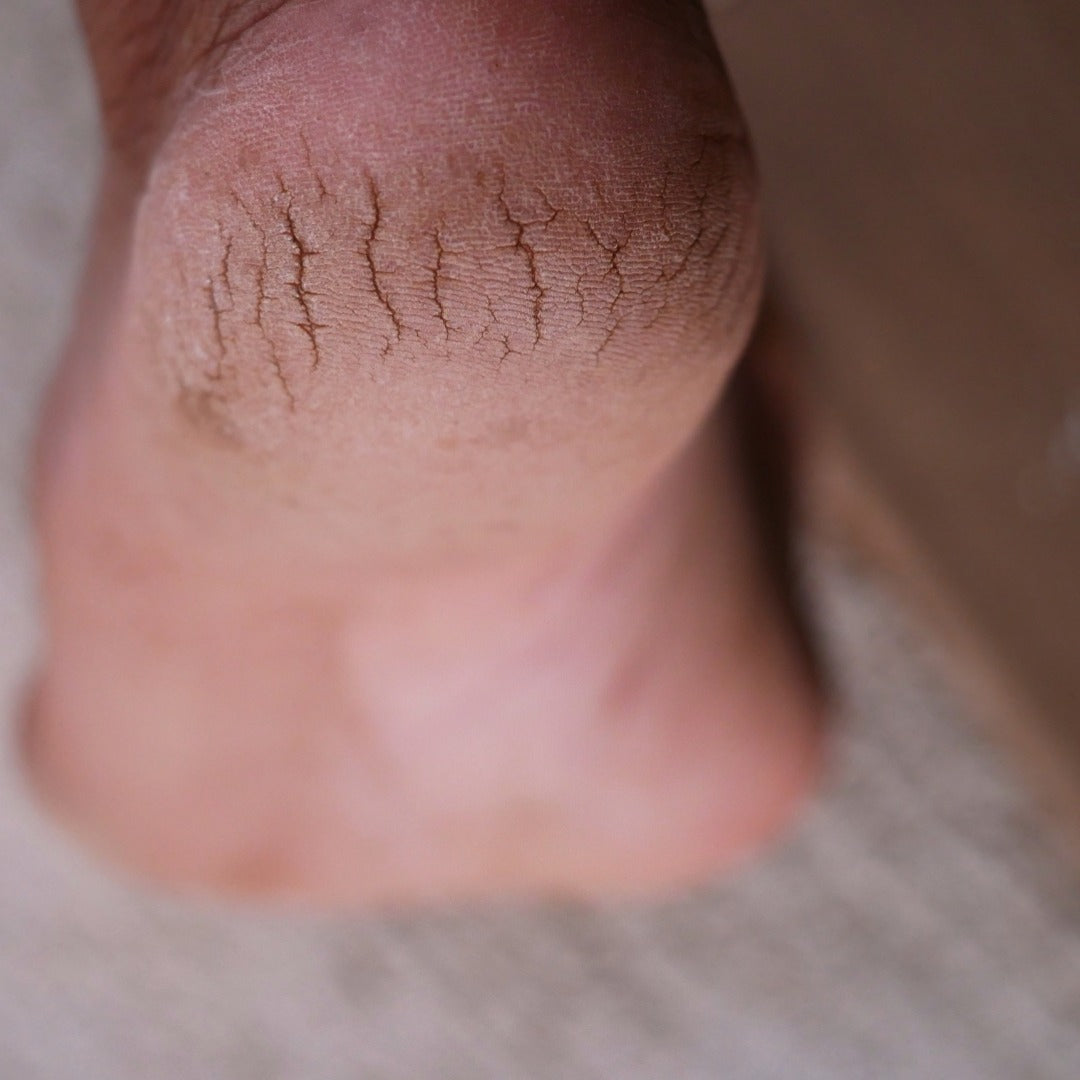 AAD Highlights Care for Dry, Cracked Heels