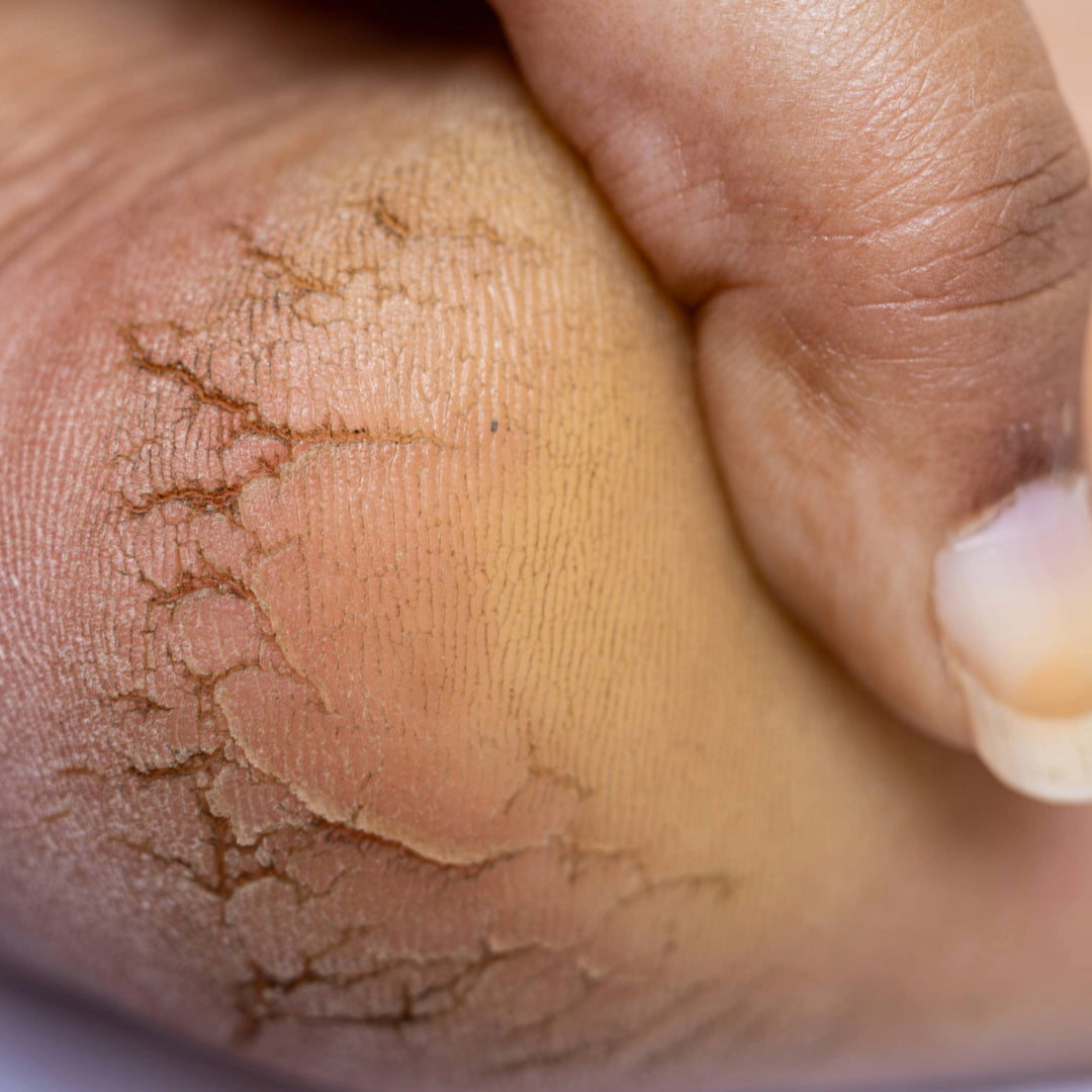 Close-up of a heel with deep cracks separating plates of thickened, dry skin