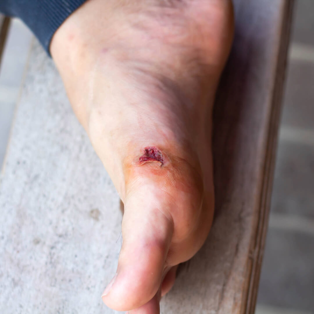 Cut Your Diabetic Foot? What to Do Now