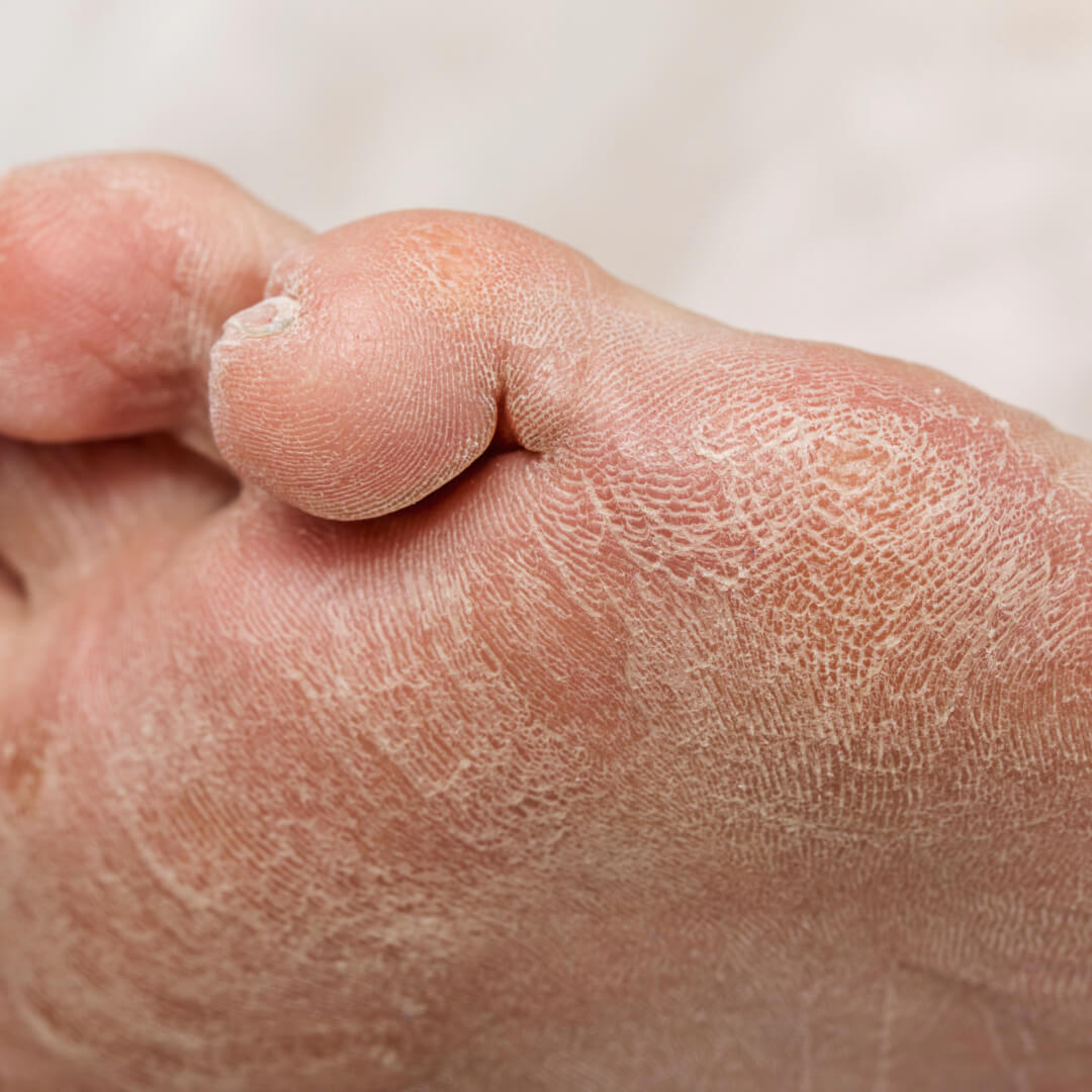 Dry diabetic foot