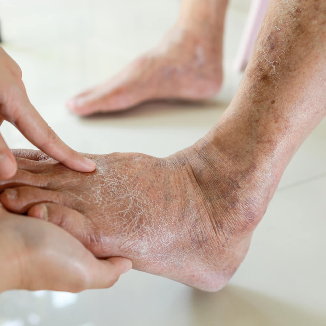 Diabetic Itchy Skin: What It Means and When to Worry