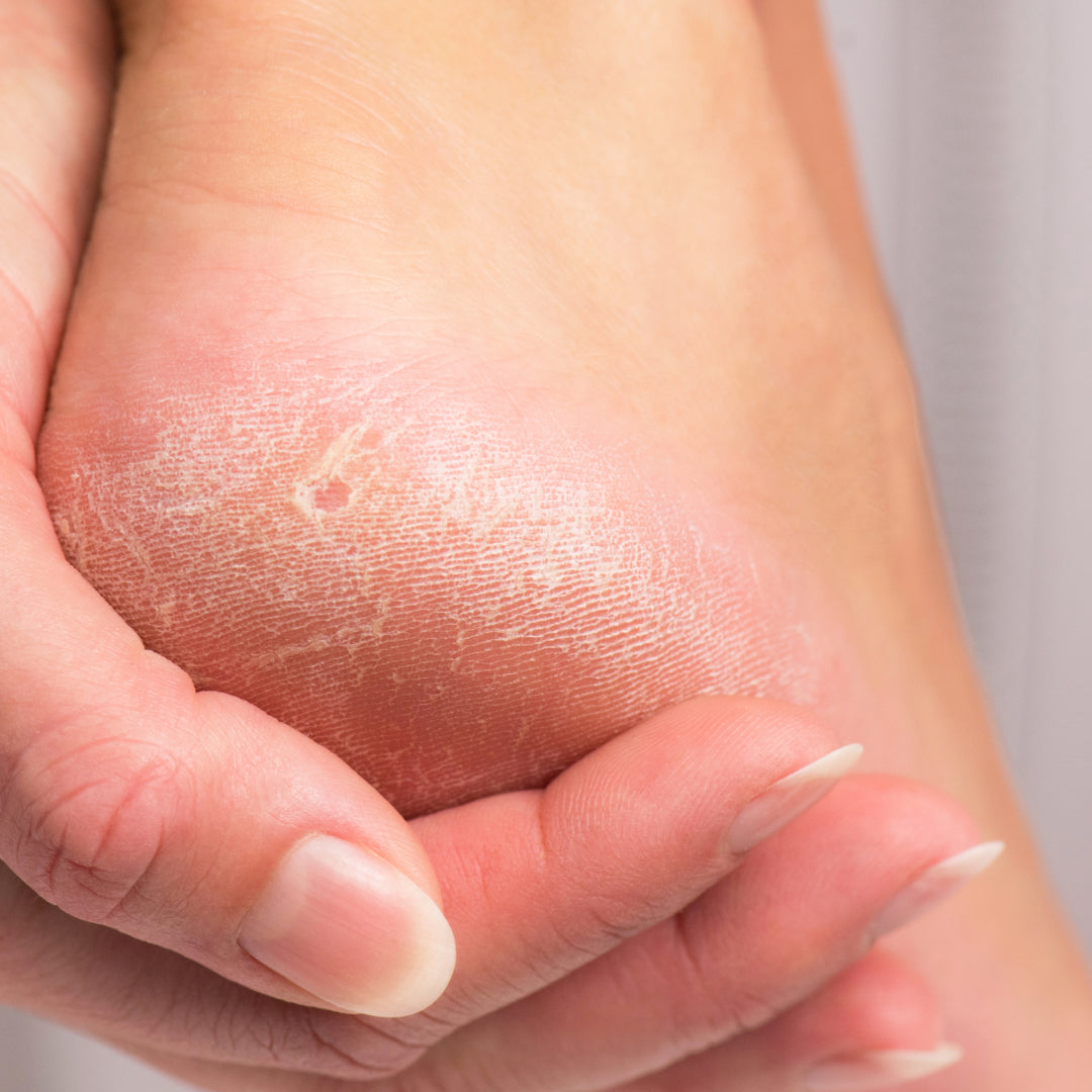 Person with hypothyroidism examining a dry, cracked heel
