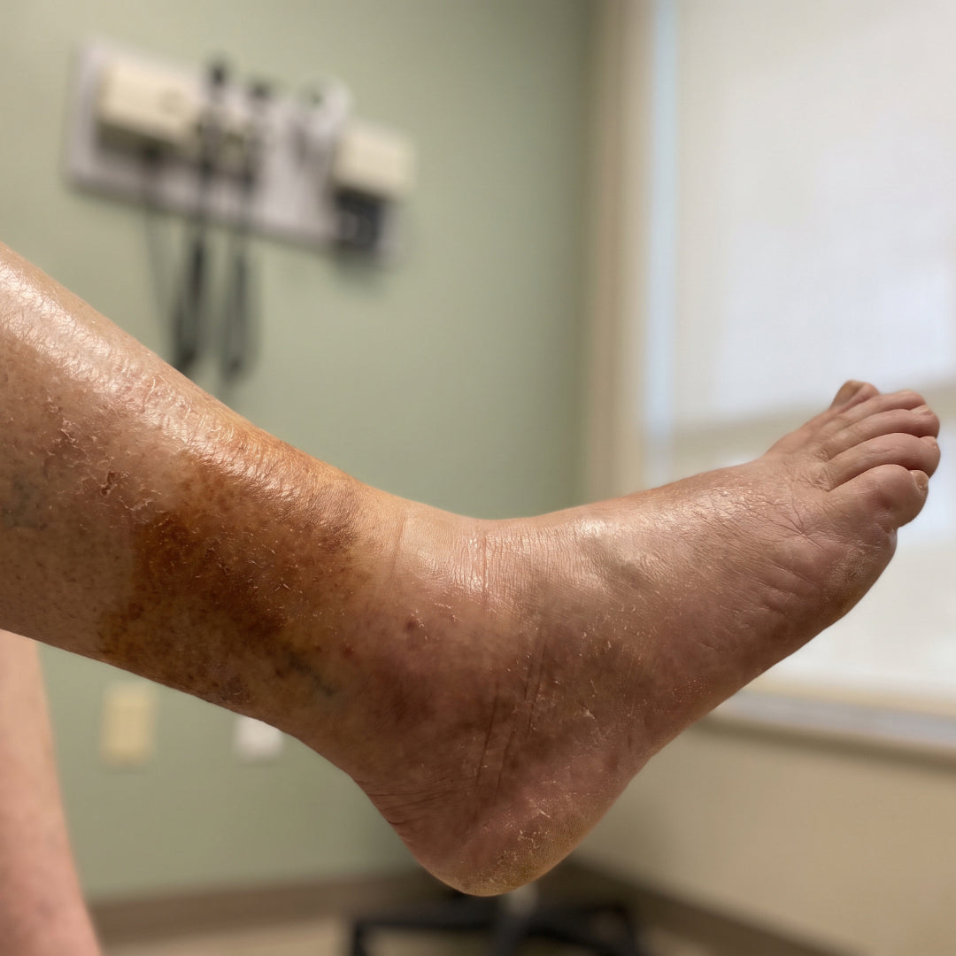 Swollen lower leg with shiny, discolored and flaking skin from chronic venous insufficiency
