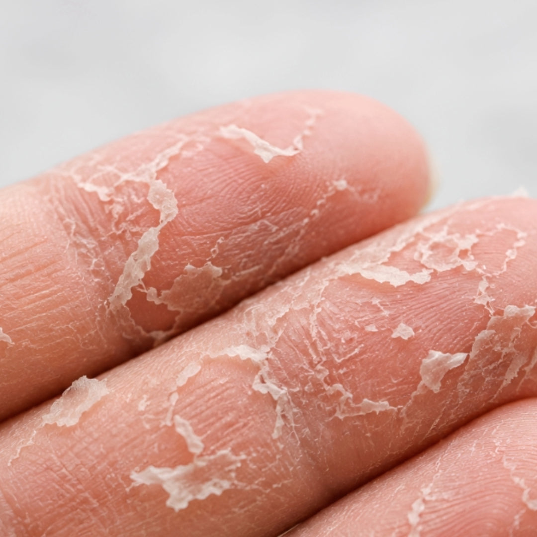 Close-up of two fingers with the outer layer of skin peeling away in dry flakes