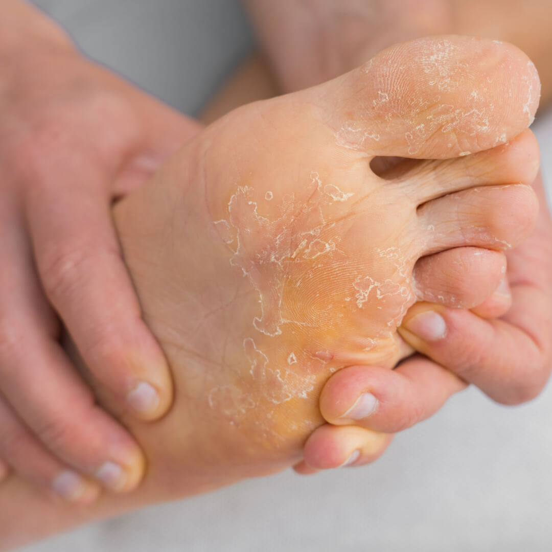 Peeling skin on the bottom of a foot