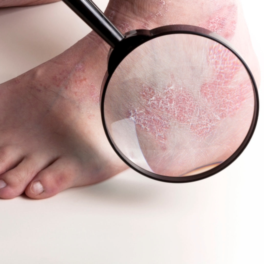 Close-up of psoriasis on the heel and ankle, showing red, scaly, and cracked skin through a magnifying glass.
