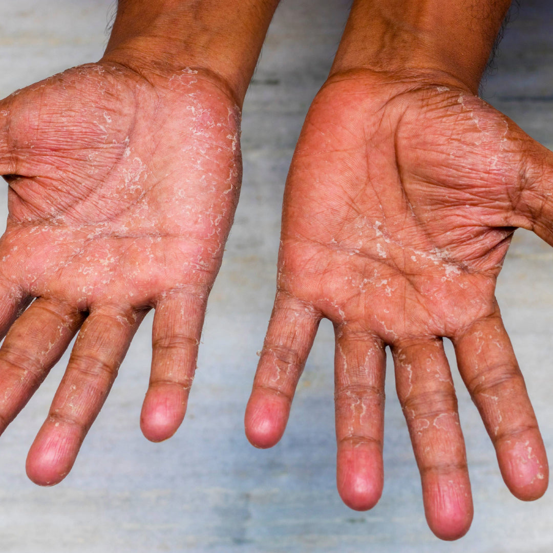 Two open palms with dry, scaling skin across the palms and fingers, as seen in palmar psoriasis