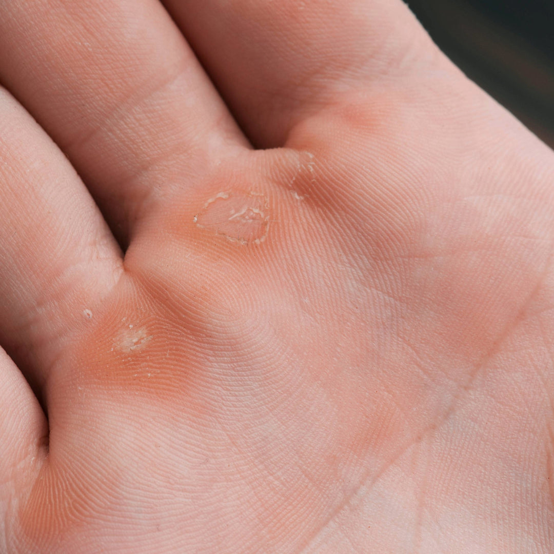 Dry, thickened callus patches on the palm at the base of the fingers
