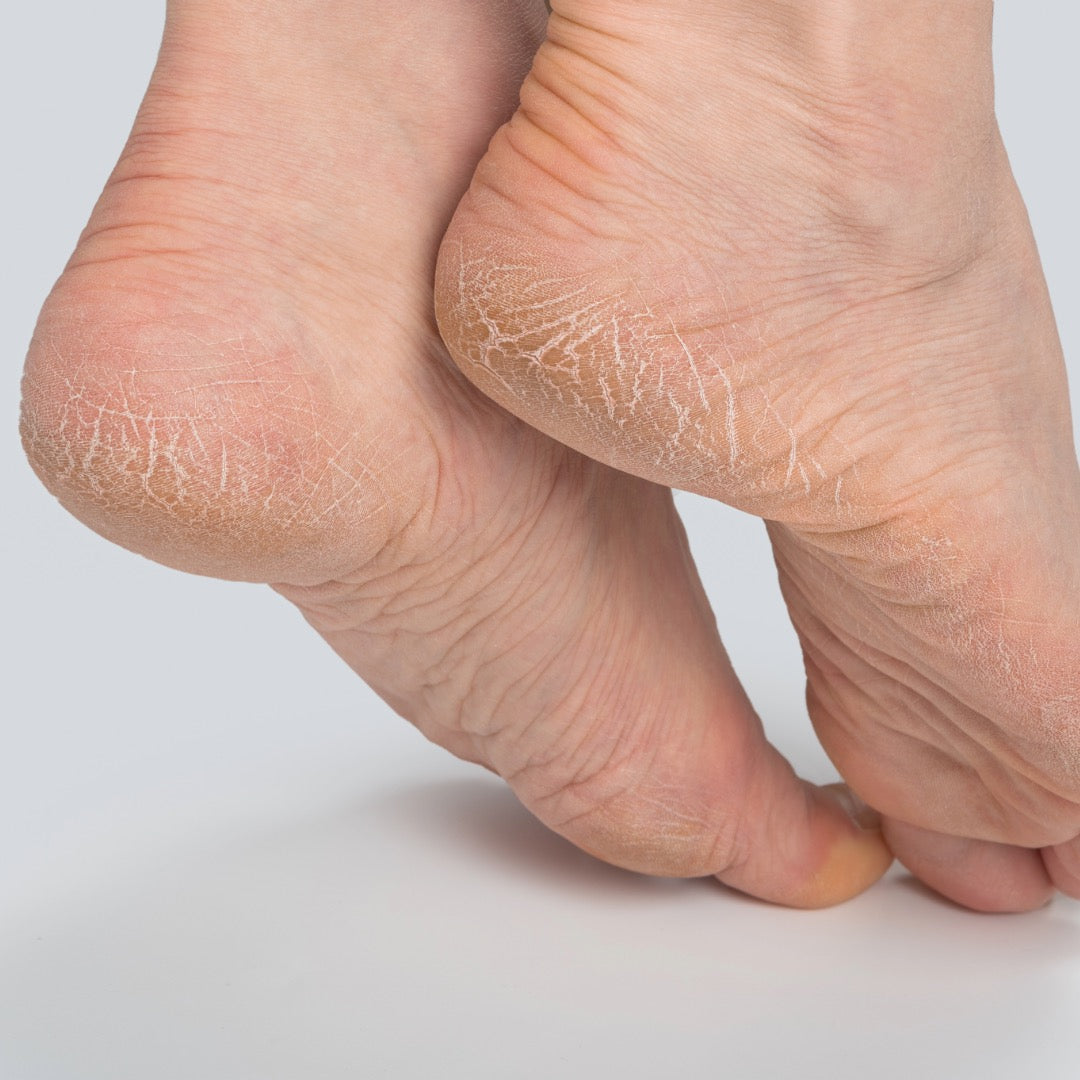 Cracked Heels