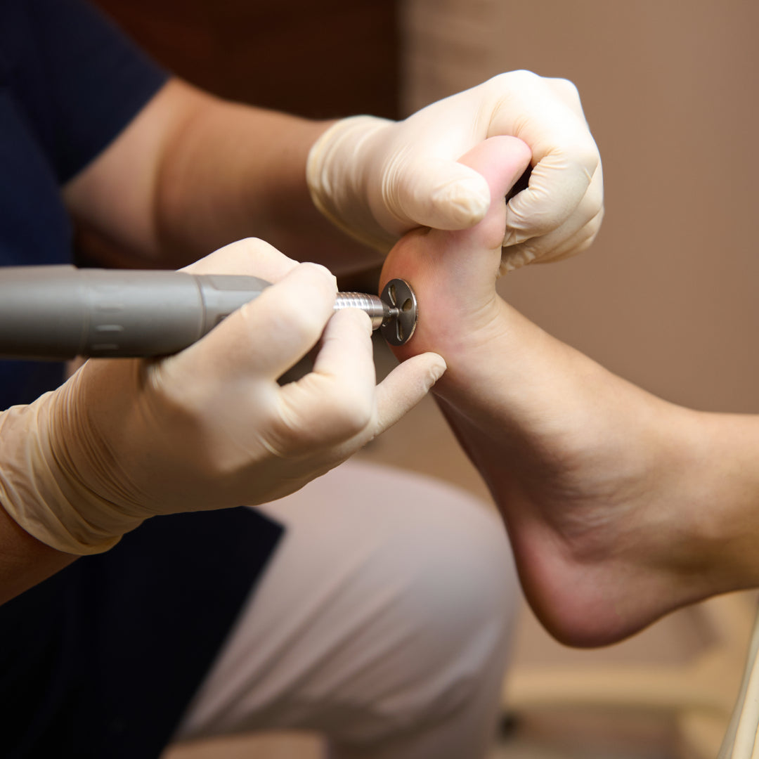 Podiatrist removing callus on foot