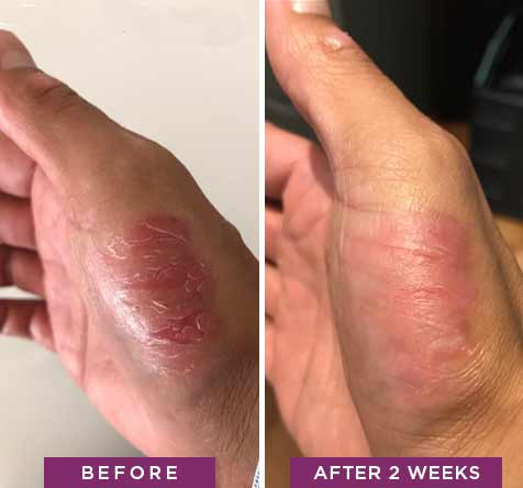 Red, irritated hands before and after using Rapid Crack Repair Cream for 2 weeks