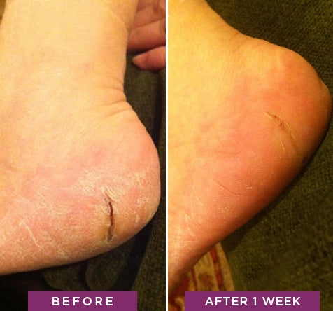Dry, cracked heels before and after using Rapid Crack Repair Cream for 1 week