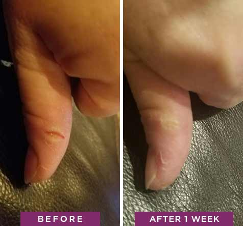 Dry, cracked finger before and after using Rapid Crack Repair Cream for one week