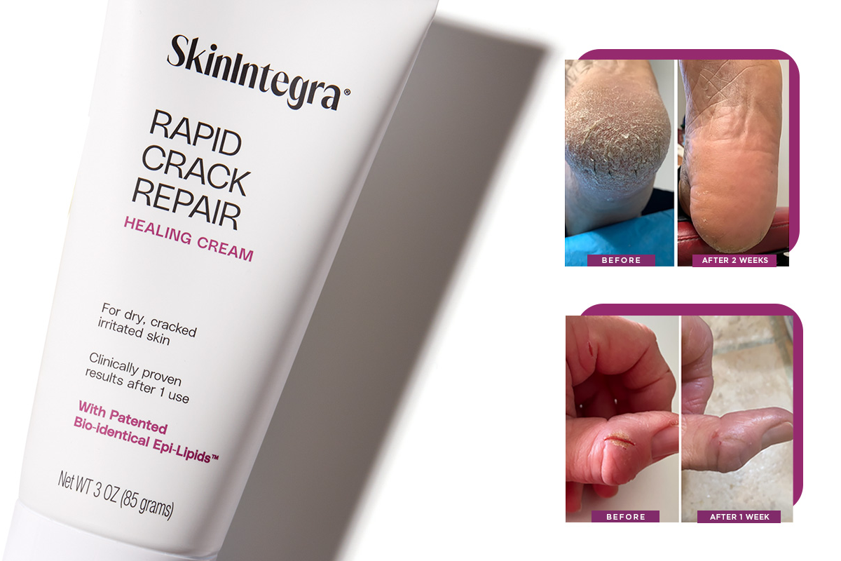 Tube of Rapid Crack Repair Cream next to cracked heels and finger images before and after using the product