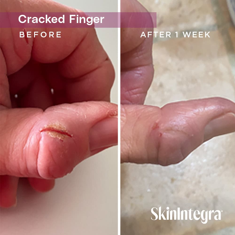 Before and after images of a cracked thumb after using Rapid Crack Repair Cream for one week