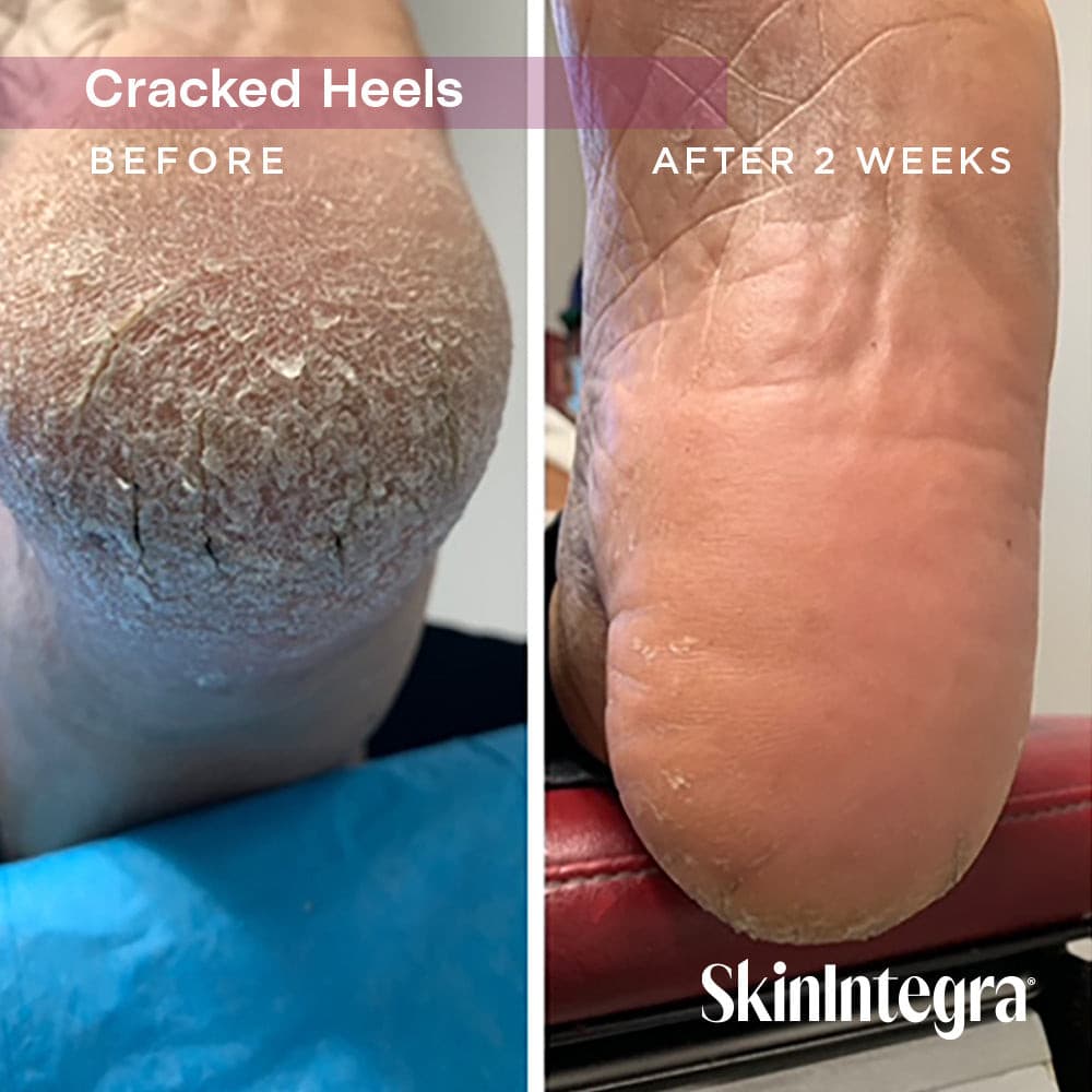 Before and after photos of cracked heels after using Rapid Crack Repair Cream for 2 weeks